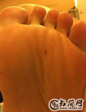 最有福气的10处吉痣:最后一个太隐蔽要好好保护