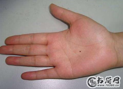 最有福气的10处吉痣:最后一个太隐蔽要好好保护