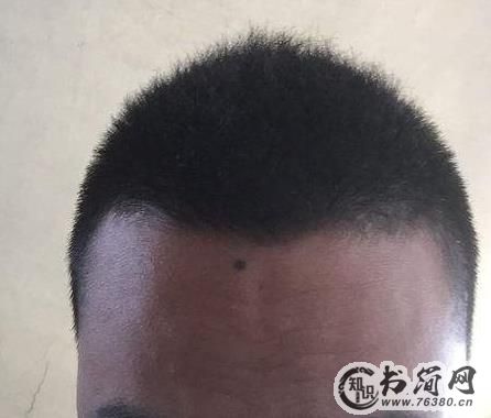 千金难买额头痣是为什么
