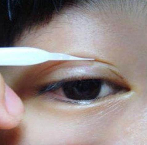 双眼皮贴怎么贴：简单步骤教程闭眼不尴尬（图）